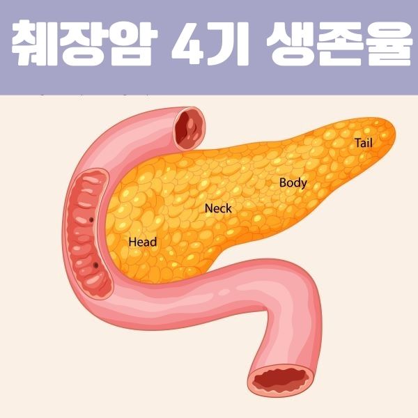 췌장암 4기 생존율